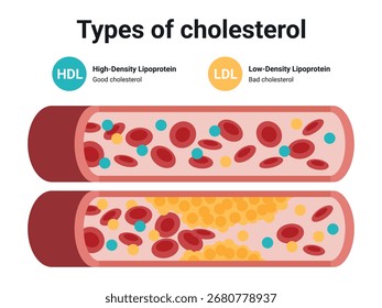 Tipo de colesterol em vasos sanguíneos humanos. LDL de lipoproteína de baixa densidade. HDL de lipoproteína de alta densidade. Artéria normal, vasculares bloqueadas, manchas gordurosas, placa, moderada. Ilustração do vetor médico.