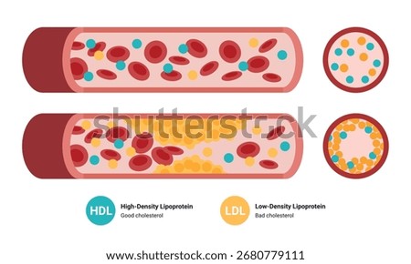 Type of cholesterol in human blood vessels. Low-Density Lipoprotein LDL. High-Density Lipoprotein HDL. Normal artery, blocked vascular, fatty streak, plaque, Moderate. Medical Vector illustration.