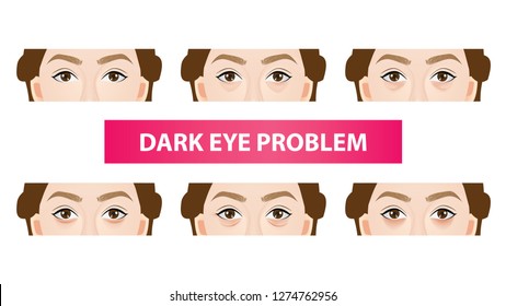 Type Of Dark Circles Under The Eyes Vector Illustration 