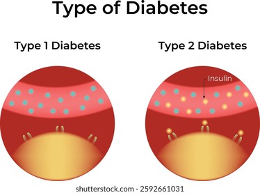 Type of Diabetes Science Design Vector Illustration Diagram