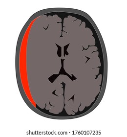 Type f head injury known as epidural bleeding.