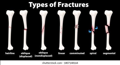 278 Types Of Joints Images Images, Stock Photos & Vectors 