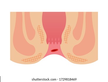 Type of Hemorrhoid flat vector illustration / bleeding hemorrhoids