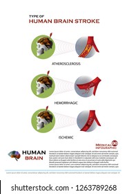 Type of human brain stroke medical infographic 