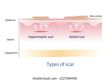 Type of keloid scar and hypertrophic scar on skin surface. Scars are caused by wounds that reach the dermis layer.