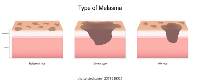 Type of melasma vector. Epidermal, Dermal and mix type. Facial skin problems.