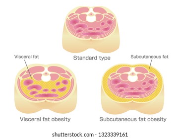 Type of obesity illustration. Abdominal sectional View. (visceral fat , subcutaneous fat)