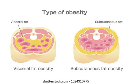 Type of obesity illustration . Abdominal sectional View (visceral fat , subcutaneous fat). 