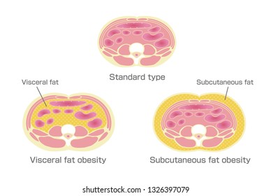 
Type of obesity illustration. Abdominal sectional View. (visceral fat , subcutaneous fat) 