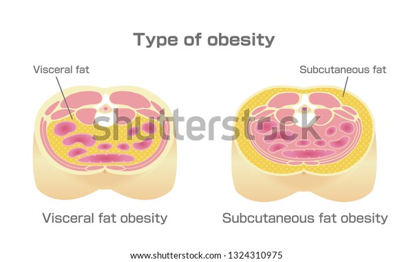肥満のイラストの種類 腹部断面図 内臓脂肪 皮下脂肪 のベクター画像素材 ロイヤリティフリー