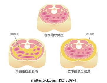 Type of obesity illustration (Japanese). Abdominal sectional View (visceral fat , subcutaneous fat). translation: Standard , Visceral fat (obecity) , Subcutaneous fat (obecity).