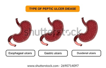 Type of peptic ulcer disease. Injuries to the inner lining of the stomach. Abdominal pain in the human body. Duodenal and gastric, vector illustration for medical, clinical, or educational.
