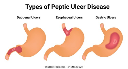 Type of Peptic Ulcer Disease Science Design Vector Illustration