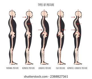 Type of posture, postural syndromes infographic. Skeletal samples of back problem kyphosis, lordosis and flat back. Normal posture medical educational poster. Vector illustration.