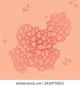 Type of psoriasis vector. Part of patients skin with dermatitis, inflammation, red rash and other skin problems. Cartoon illustration for disease concept