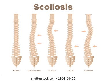 type, scoliosis medical anatomical vector / backbone / organ