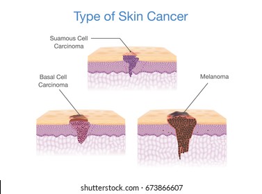 Type Of Skin Cancer In 3D Vector Style. Medical Illustration.