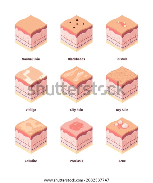 Type Skin Dermis Structure Human Body Stock Vector (Royalty Free ...