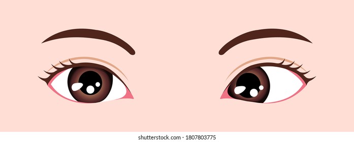 Type of strabismus vector illustration / Esotropia