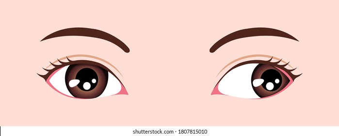 Type Of Strabismus Vector Illustration / Exotropia