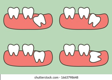 tipo de sabiduría que afecta los dientes a otros dientes - caricatura dental vector estilo plano personaje adorable para el diseño