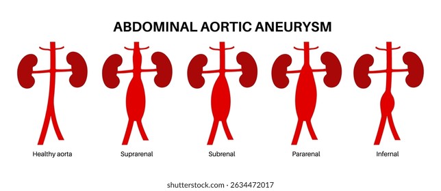 Tipos de infográfico de aneurisma da aorta abdominal, classificados por localização. Suprarrenal, sub-renal, pararrenal e infrarrenal. Diagrama de anatomia cardiovascular humana cartaz médico ilustração vetor plana