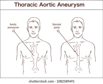 Types of abdominal aortic aneurysm. normal aorta and enlarged vessels. Vector diagram