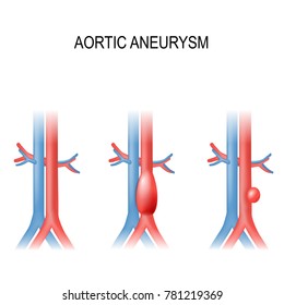 Types Of Abdominal Aortic Aneurysm. Normal Aorta, And Enlarged Vessels. Vector Diagram