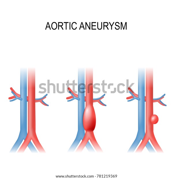 Classification Abdominal Aortic Aneurysms Healthy My Xxx Hot Girl