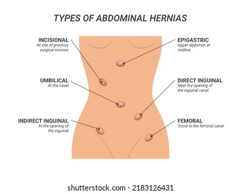 Types of abdominal hernias illustration on isolated background