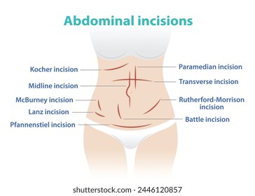 Tipos de incisión abdominal para Ilustración vectorial quirúrgica aislada sobre fondo blanco. Kocher, Midline, McBurney, Lanz, Pfannenstiel, Paramedian, Transverse, Rutherford Morrison, Incisión de batalla.