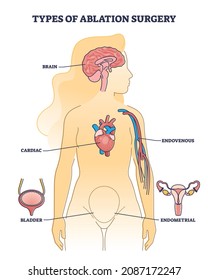 Types of ablation surgery with brain and cardiac example outline diagram. Labeled educational medical procedure and catheter ablation with endometrial, bladder or endovenous method vector illustration