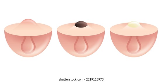 Types of acne 3D icons - pimples, blackhead, whitehead. Problems in skin pores