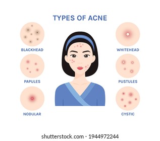 Types of acne. Beautiful Asian Woman with Problem Skin on her  Cute Face. Acne treatment. Flat color cartoon style. White background. Vector stock illustration.
