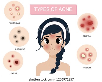 Types of acne by occurring on the face of the girl braided hair.