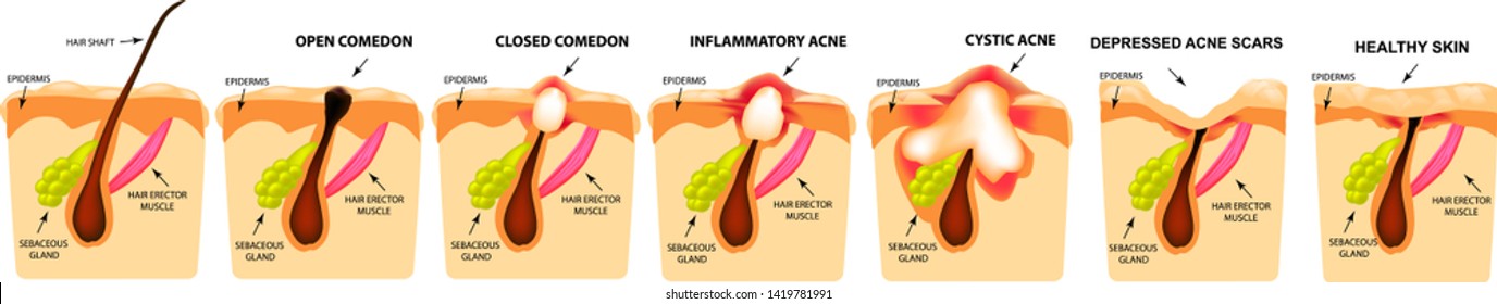 Types of acne. Closed comedones, open comedones, inflamed acne, cysts. Inflamed pimples. The structure of the skin. Scar acne and pimples. Infographics. Vector illustration on isolated background.