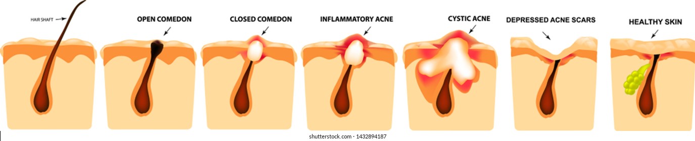 Types of acne. Closed comedones, open comedones, inflamed acne, cysts. Inflamed pimples. The structure of the skin. Scar acne and pimples. Infographics. Vector illustration on isolated background.