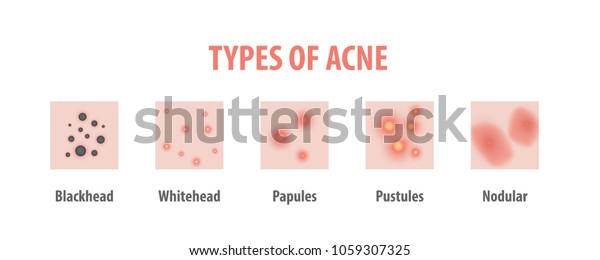 Types Acne Diagram Illustration Vector On Stock Vector (Royalty Free ...