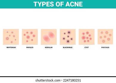 Types of Acne Diagram for Skin Problems Content. Stock Vector Illustration