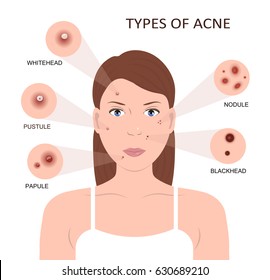 Types of acne. Girl with skin problems. Woman with pimples on the face. Vector illustration flat design