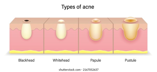 Types of acne. Human skin acne. Blackhead, Whitehead, Papule and Pustule. Vector for cosmetic advertisements.