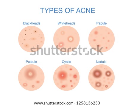 Types of Acne  icon for skin problems content. Illustration about dermatology diagram.