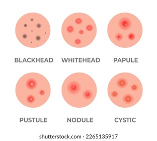 Types of acne illustration. Pimples, skin pores, blackhead, whitehead, scar, comedone. Skincare problems and inflammation. Acne skin types