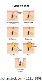 Types of acne illustration set (skin care)