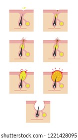 Types of acne illustration set (skin care) / No text