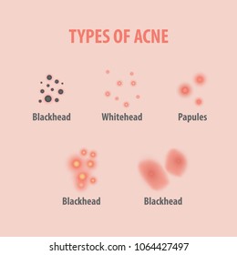 Types of acne illustration vector on white background, Beauty concept.