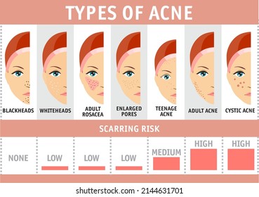 Types of acne infographics. Vector illustration types of acne, pimples, skin pores, blackhead, whitehead, scar, comedones. Isolated on white background. Girl with acne. Beauty skin care concept