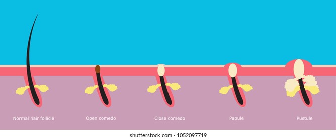 Types of acne a long-term skin disease that occurs.