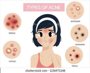 Types of acne occur on the face of the girl shot hair.