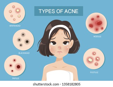 Types of acne occur on the face of the girl shot hair. 